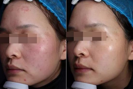 光子嫩肤效果图