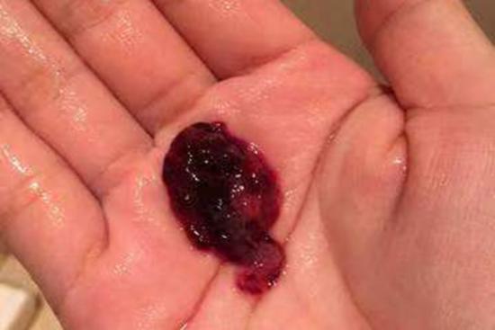 生化妊娠排出物图片