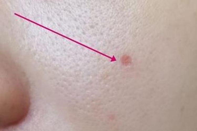 激光点痣后10天恢复图
