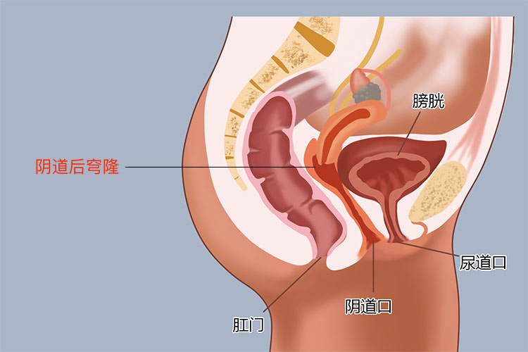 阴道后穹隆位置图 阴道后穹隆位置图