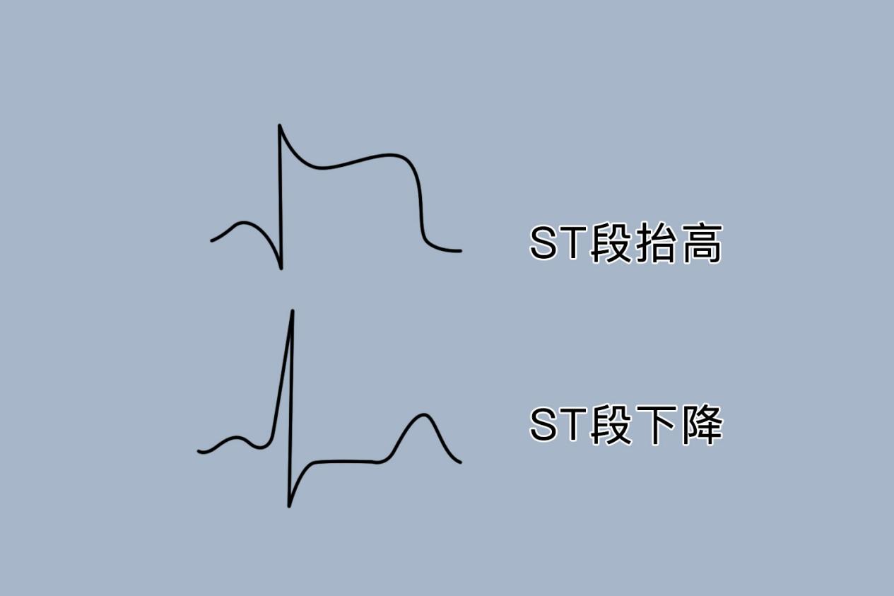 st弓背向下抬高图片