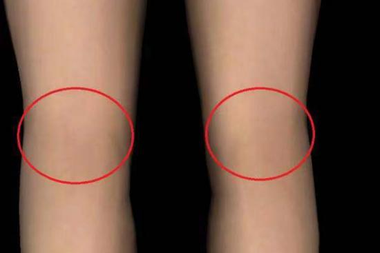 腘窝准确位置图