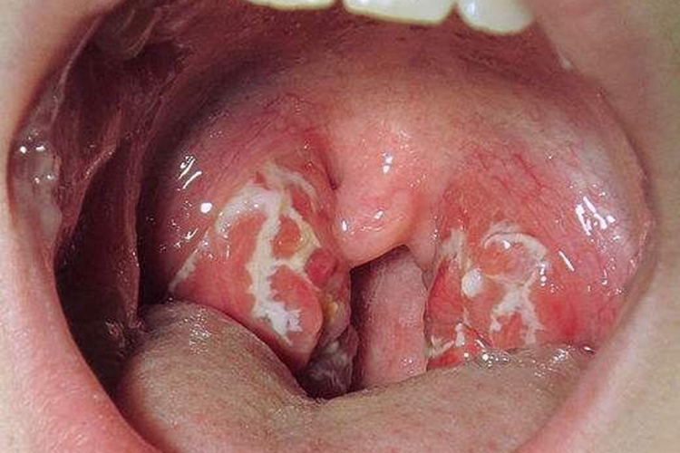 小孩扁桃体肿大图