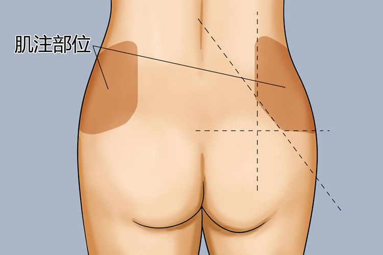十字法肌肉注射简易图