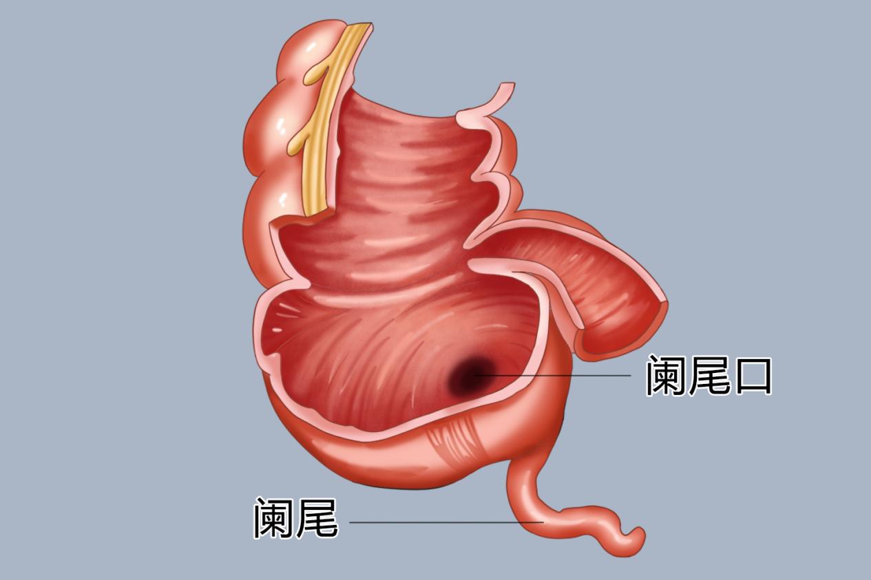阑尾的解剖结构示意图图片