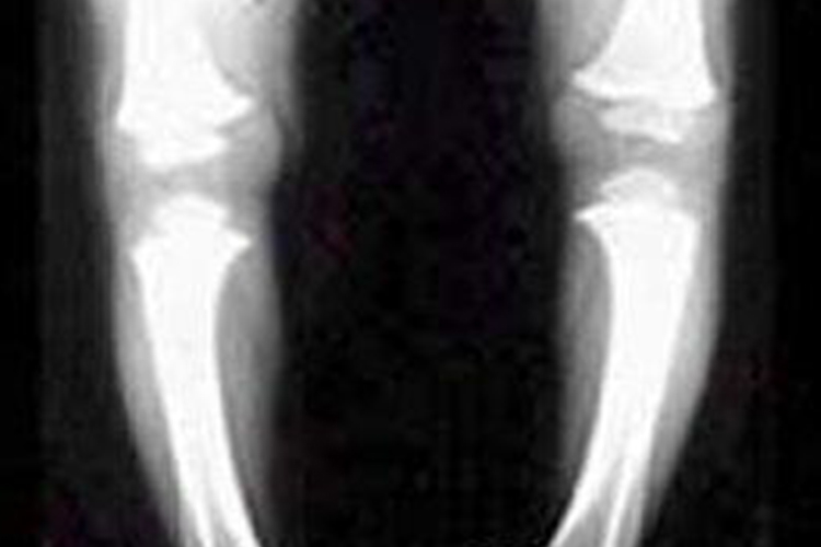 宝宝O型腿X线摄片图