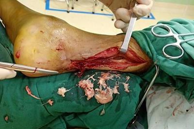 清除失活组织图 清除失活组织图