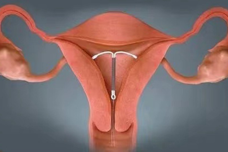 宫内节育环位置图