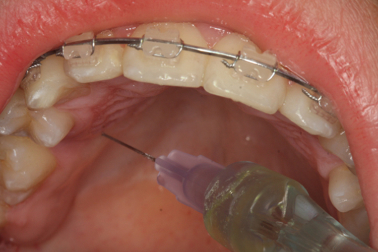 局部麻醉图 局部麻醉图