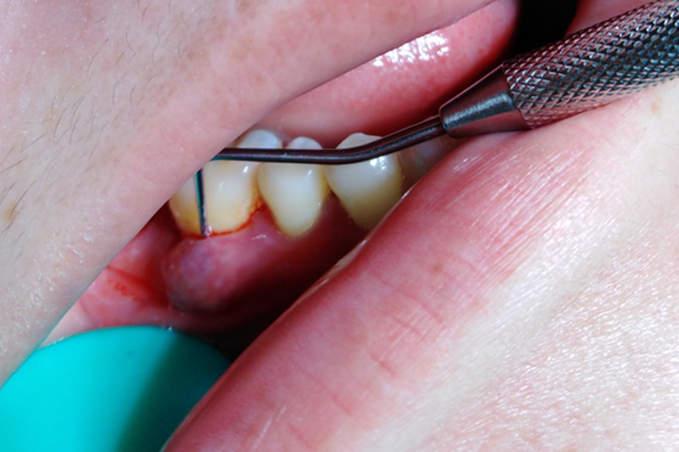 牙周脓肿尖探针刺入图 牙周脓肿尖探针刺入图