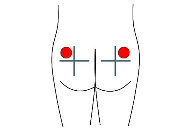 催生针肌内注射位置图