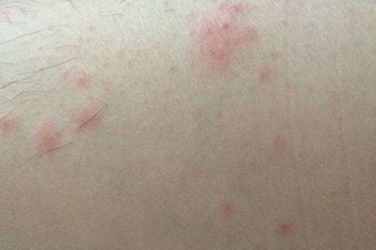 蜘蛛咬了红肿痒图