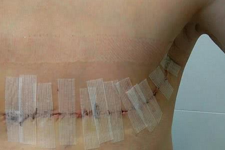 乳腺癌全切后恢复图