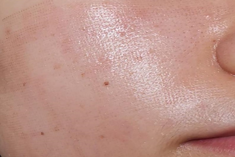 点阵激光术后红肿图