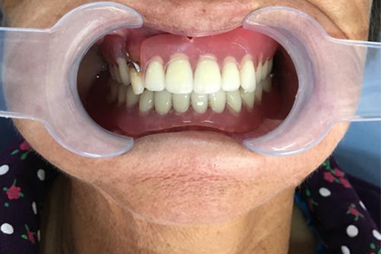 隐形义齿图