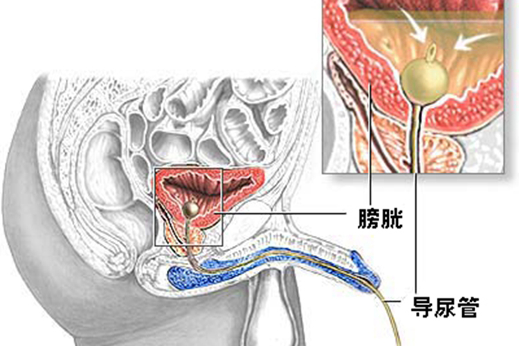 男性导尿位置图