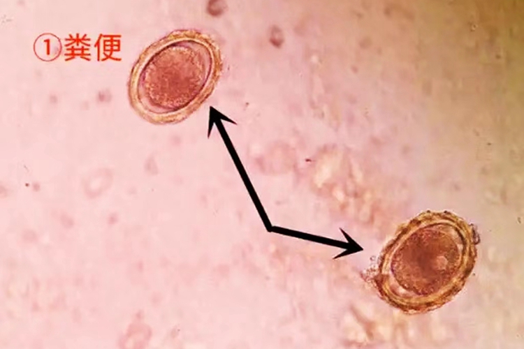 蛔虫虫卵图