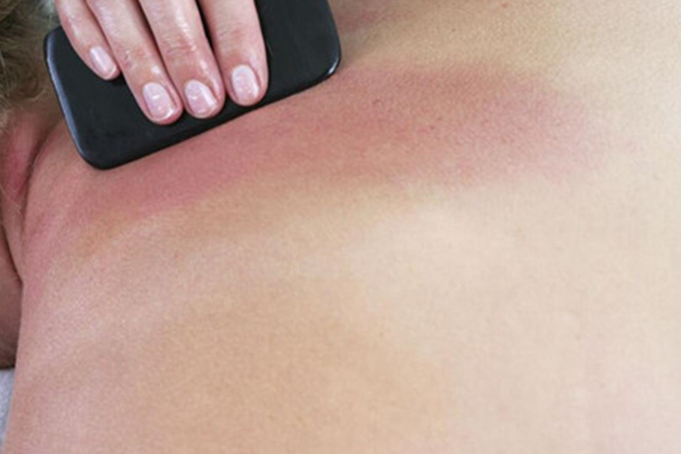 后背刮痧淡红色痧斑图