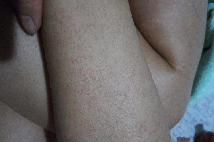 白血病皮肤出血点图