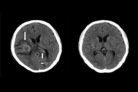 白血病颅内出血影像图
