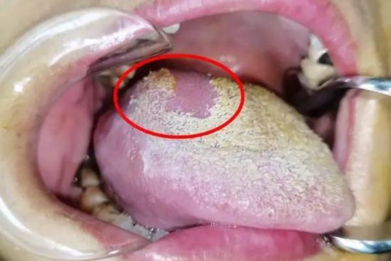 舌根部乳头瘤图片