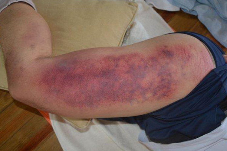 痧象呈紫红色图