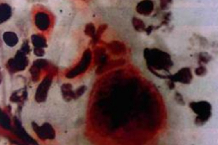 高分化鳞癌细胞图