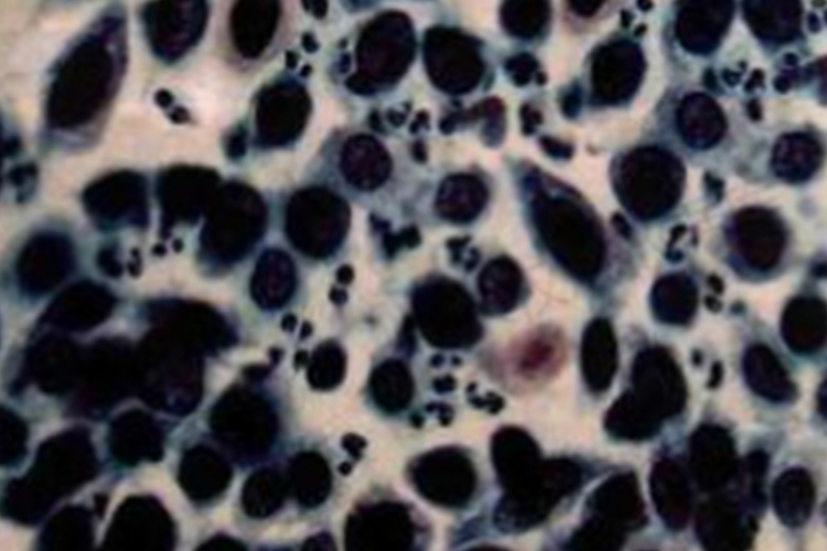 低分化鳞癌细胞图