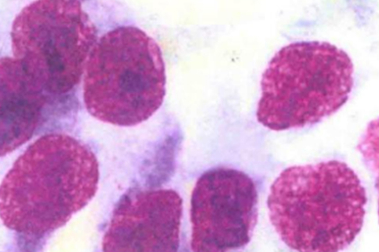 高分化腺癌细胞图