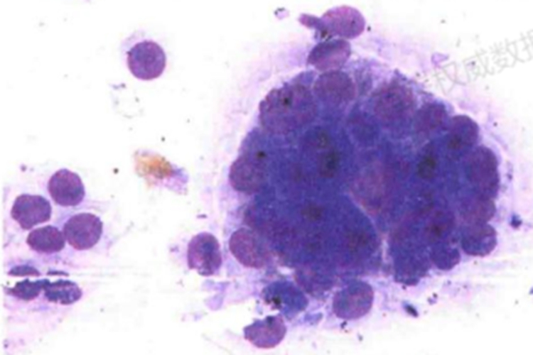 低分化腺癌细胞图