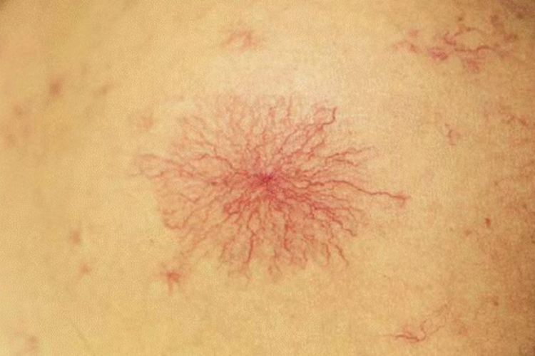 肝硬化蜘蛛痣图