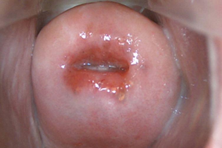 轻度宫颈柱状上皮异位图