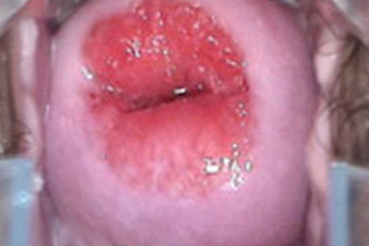 中度宫颈柱状上皮异位图