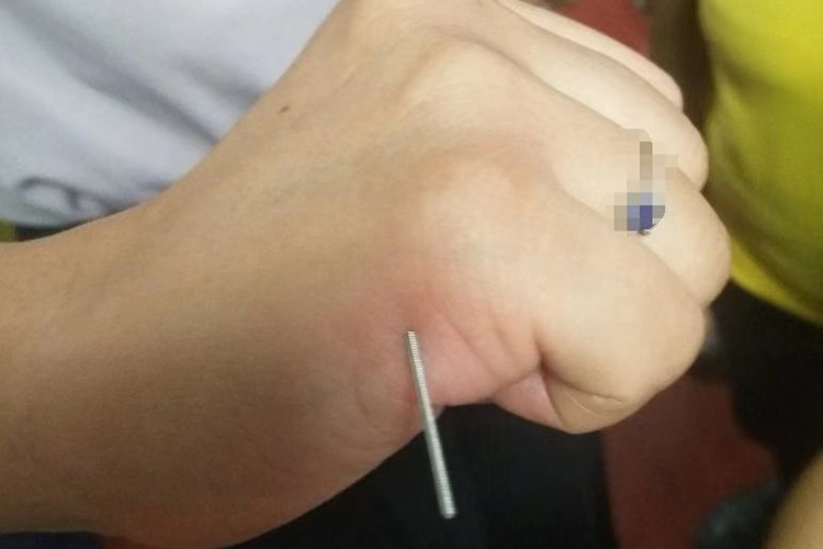 后溪穴针灸图片