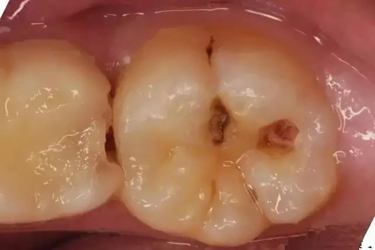 牙齿中龋牙体缺损图