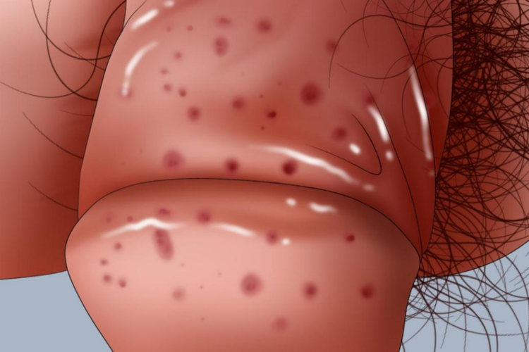 白色念珠菌性包皮龟头炎红点图