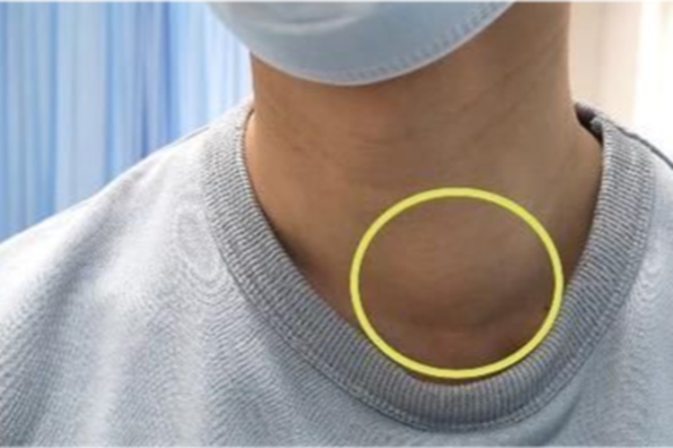 甲状腺囊肿图