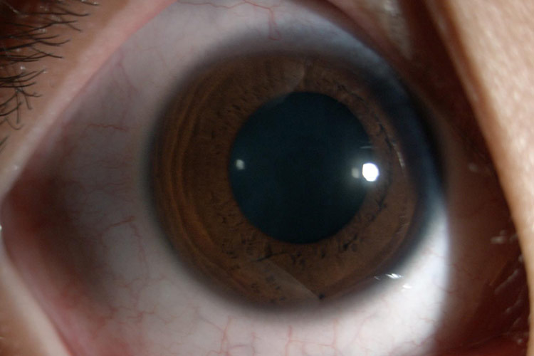 过敏性结膜炎结膜充血图