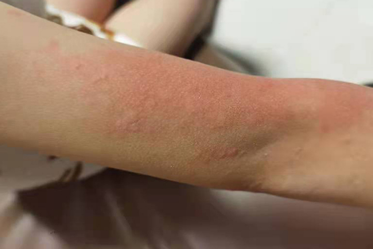 荨麻疹风团样改变图