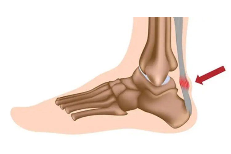 跟腱周围炎位置图片图片