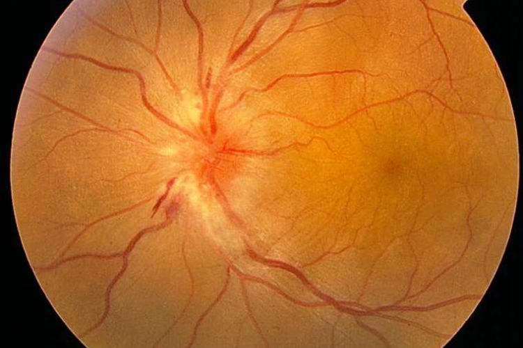 视神经乳头水肿图