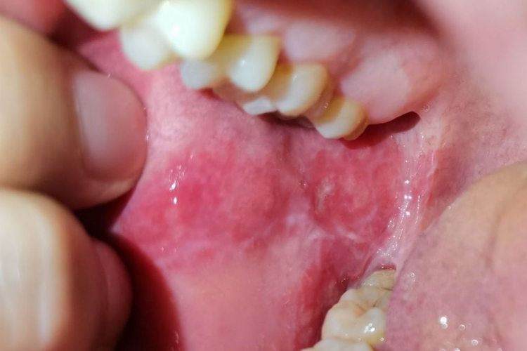 口腔扁平苔藓图