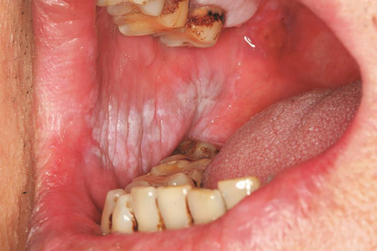 口腔白色角化病图