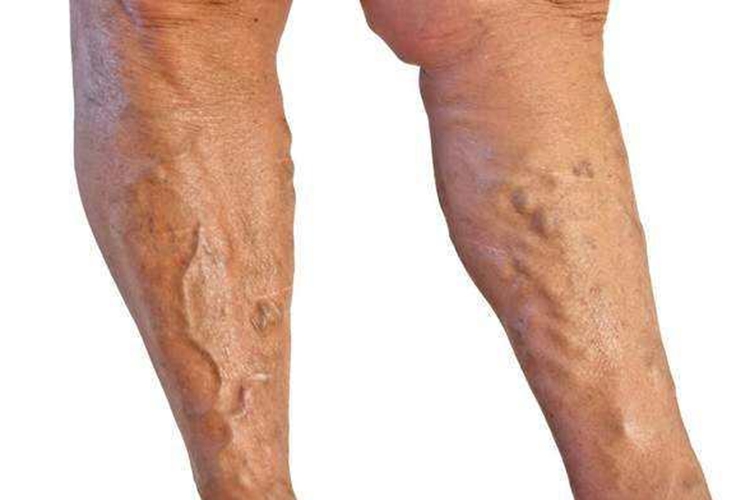 下肢静脉曲张图