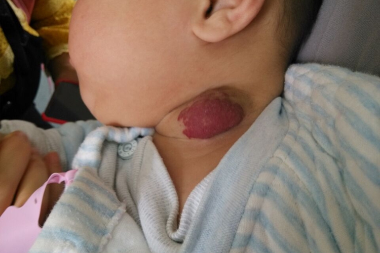 颈部毛细血管瘤 颈部毛细血管瘤