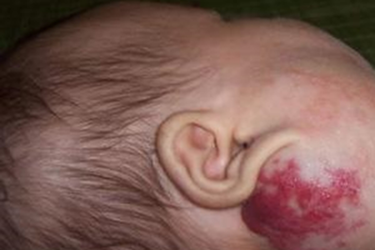 颈部海绵状血管瘤图 颈部海绵状血管瘤图