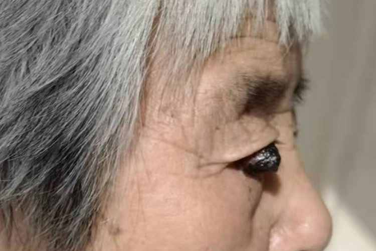 脸部黑色素瘤图