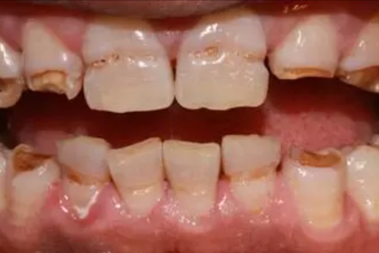 大门牙中间烂了个窟窿图片