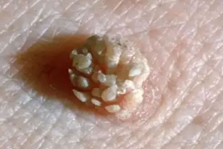 鸡冠状尖锐疣图