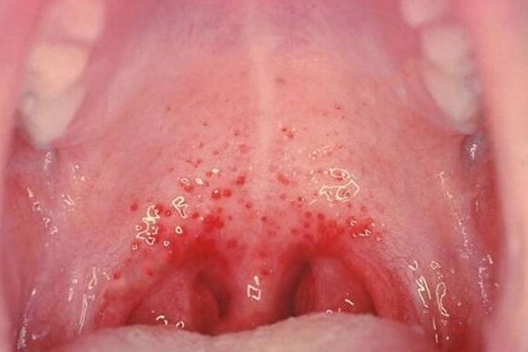 儿童疱疹性咽峡炎前驱期图
